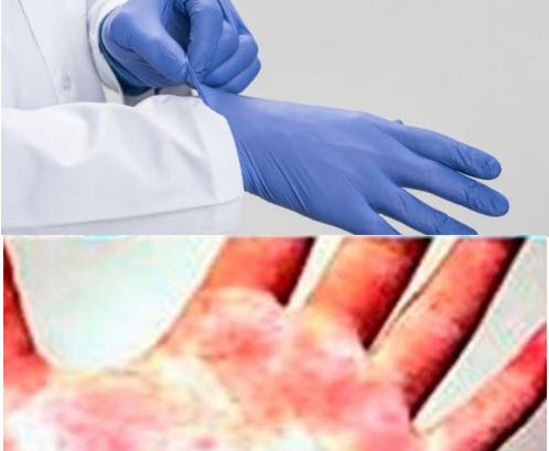 Qué guantes son los más indicados para alérgicos al látex